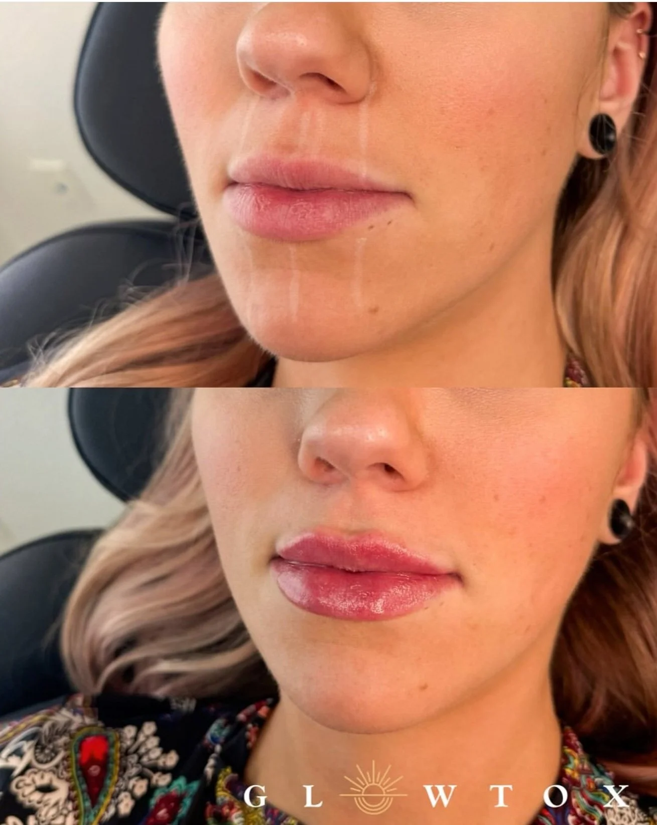 Lip filler before and after at Glowtox, natural volume on upper and lower lip