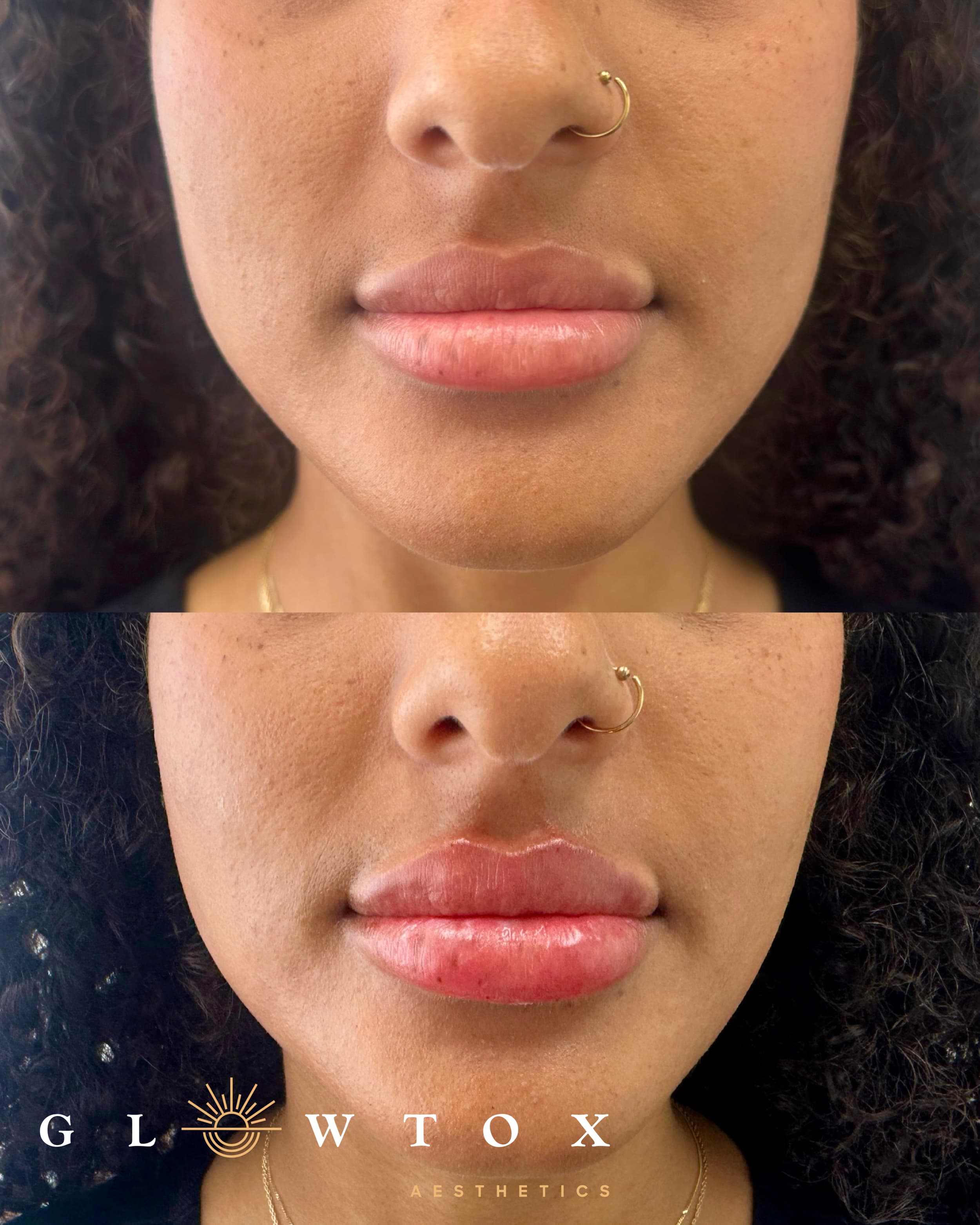 Lip filler before and after at Glowtox, fuller lips and improved projection
