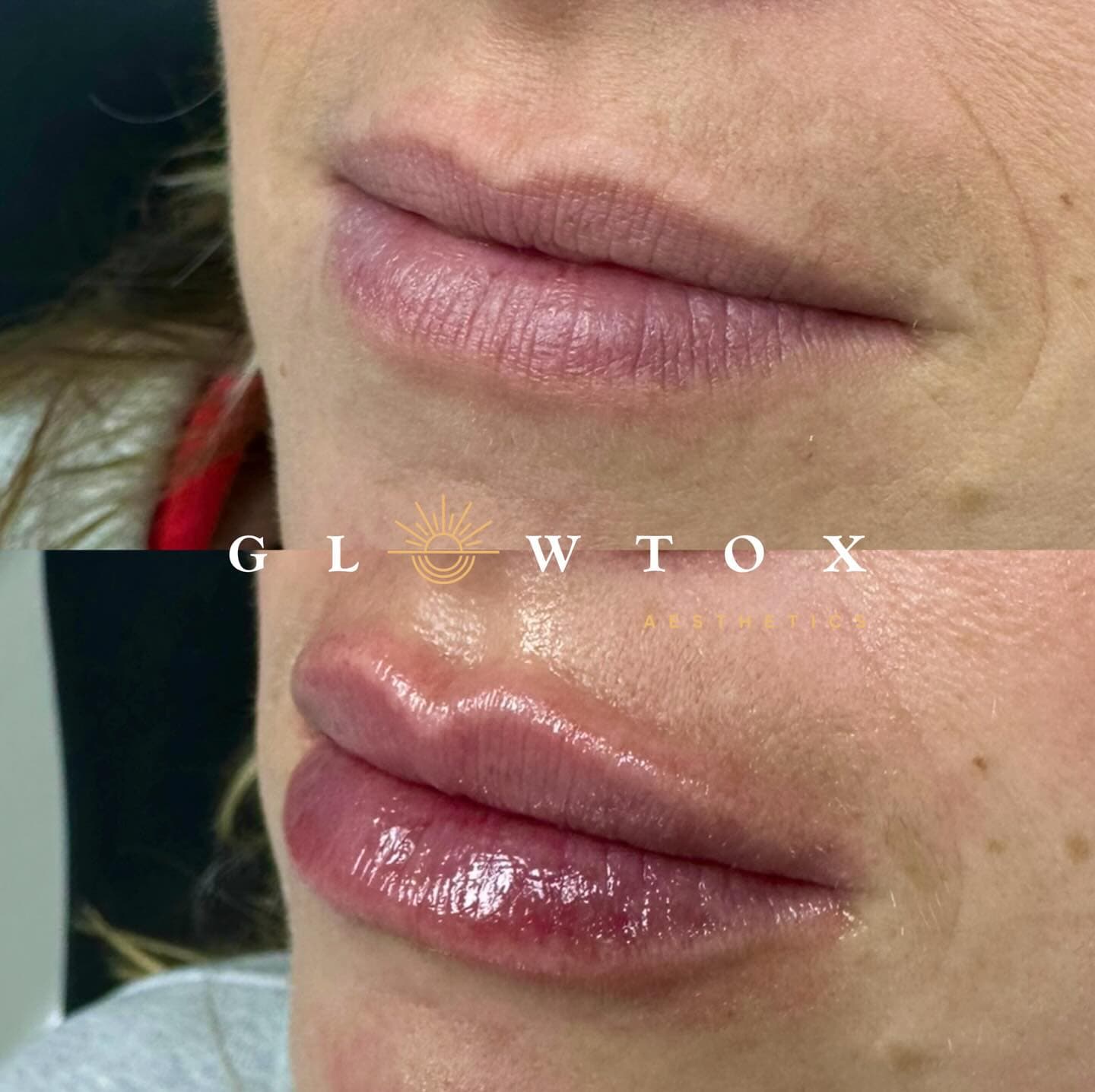 Lip filler before and after at Glowtox, enhanced lip projection
