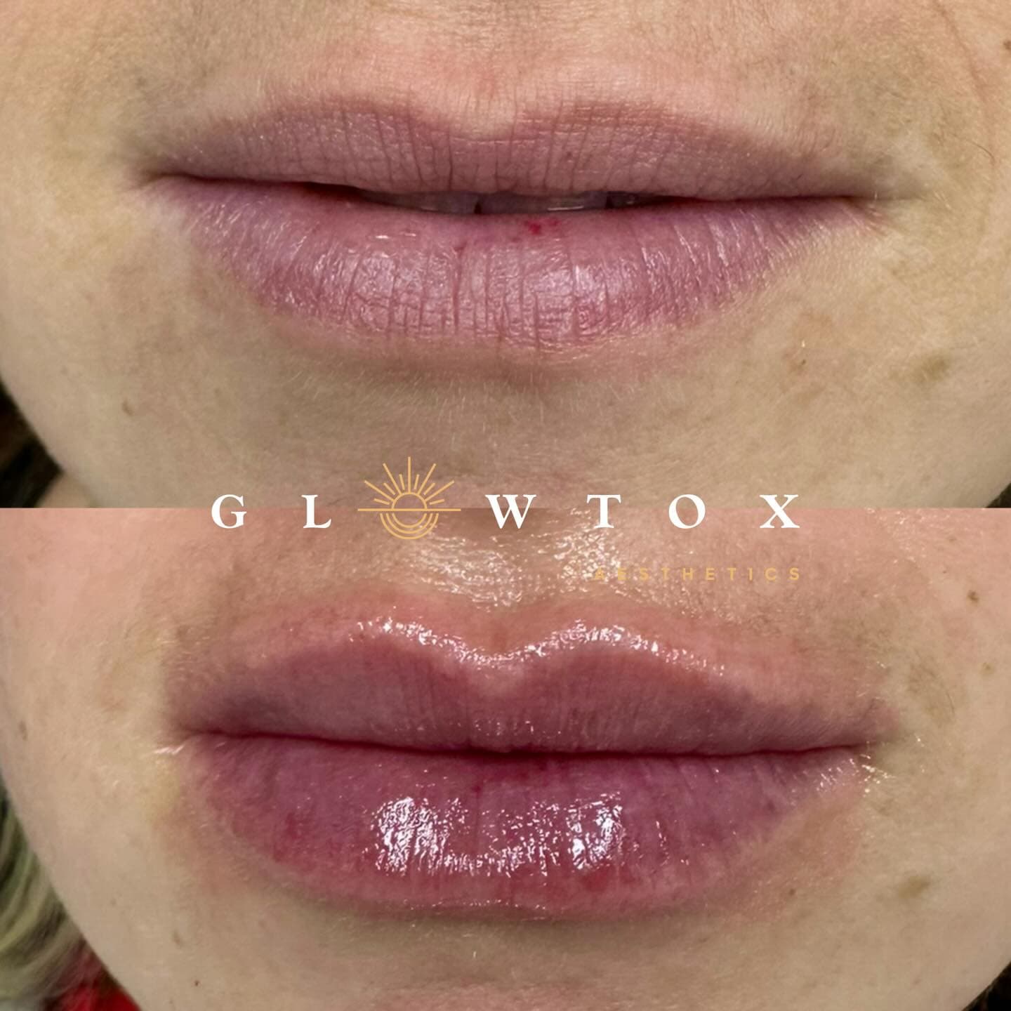 Lip filler before and after at Glowtox, cupid's bow definition