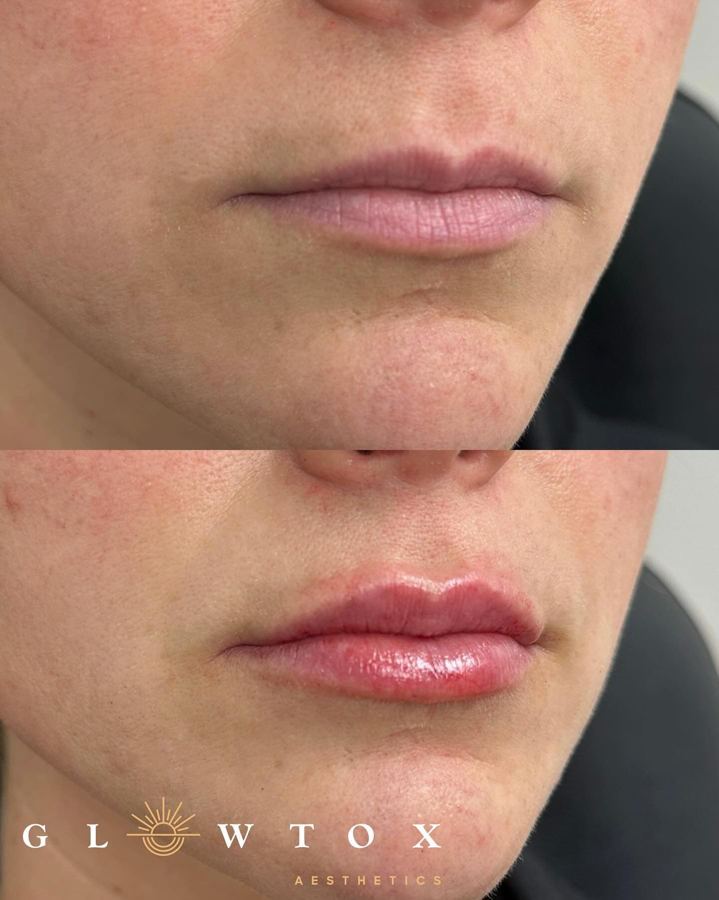 Lip filler before and after at Glowtox, conservative result