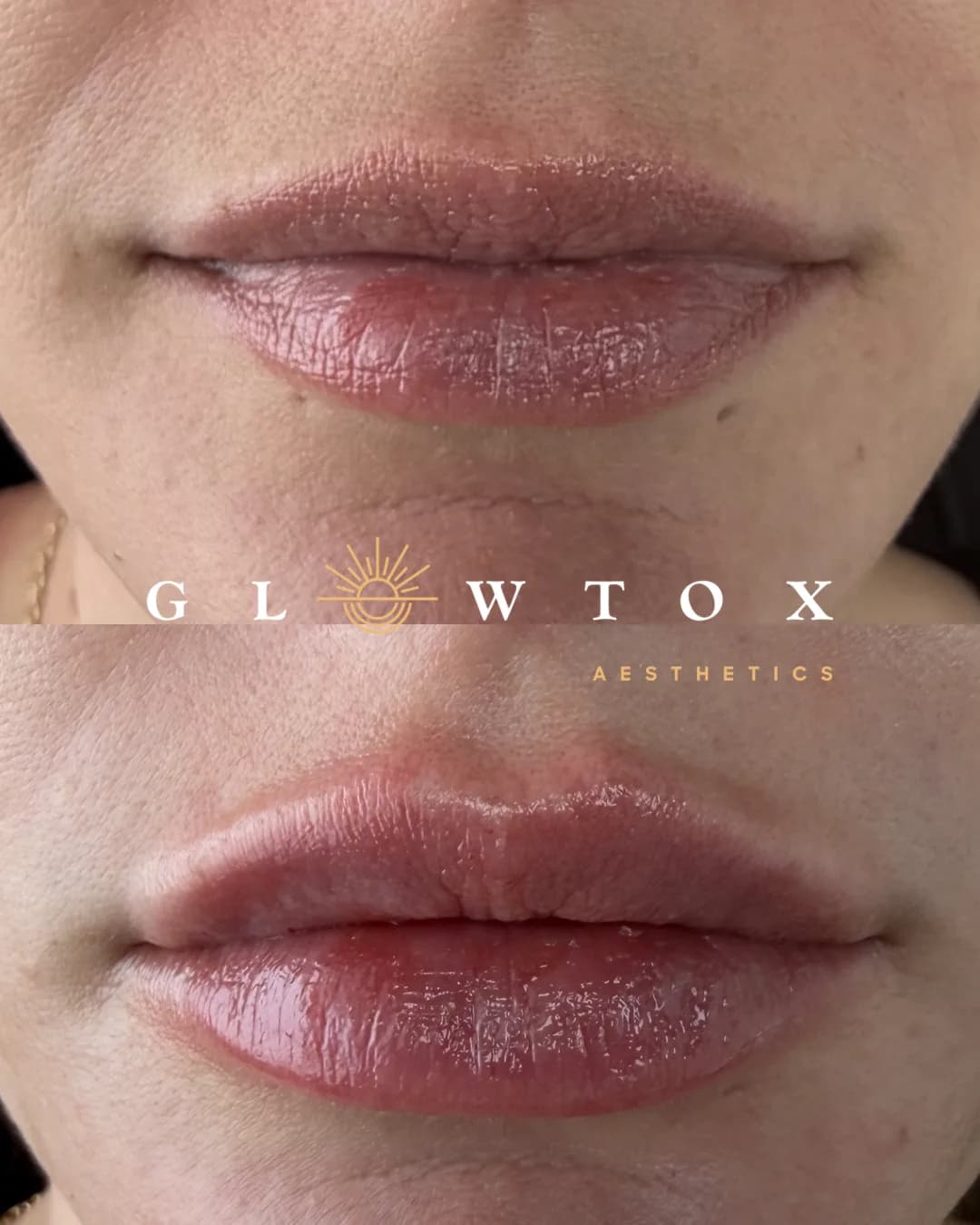 Lip filler before and after at Glowtox, soft natural enhancement