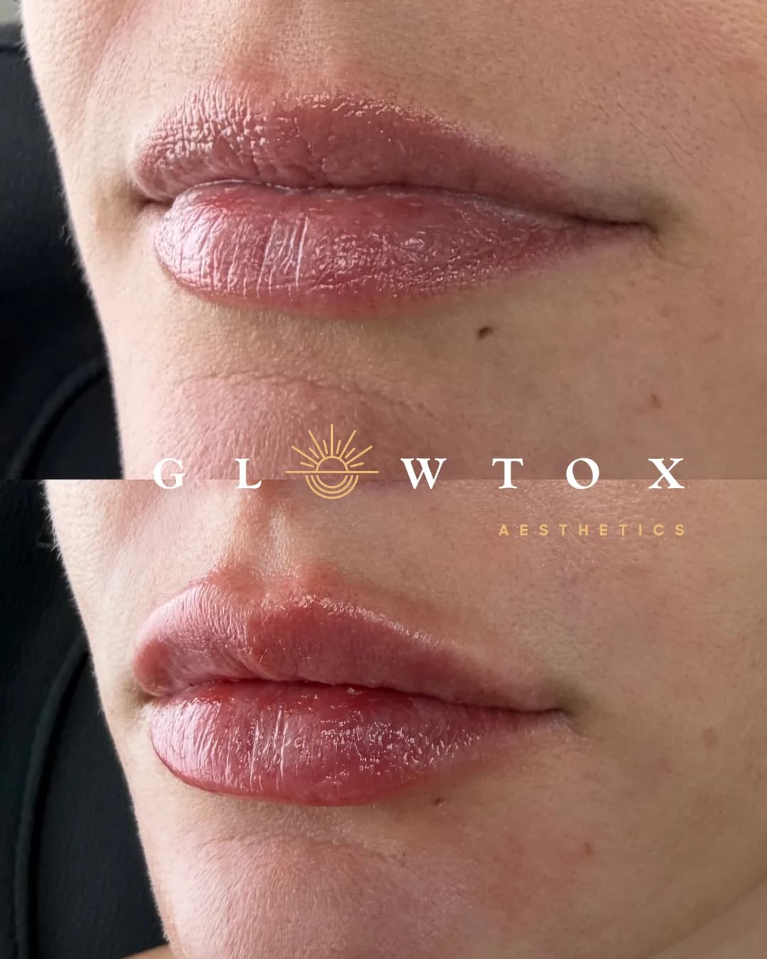 Lip filler before and after at Glowtox, fuller upper lip and balanced shape