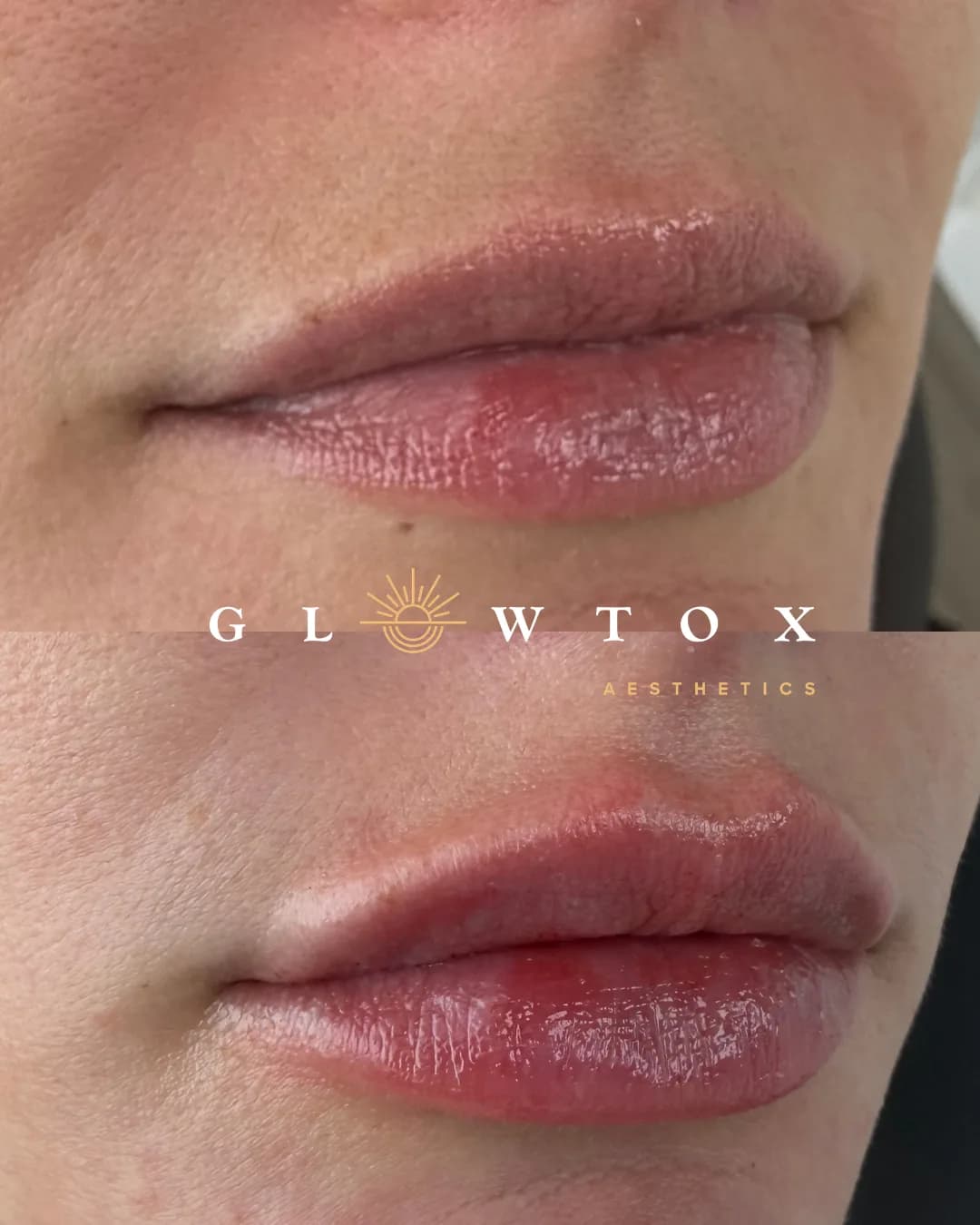 Lip filler before and after at Glowtox, plumper volume with natural projection