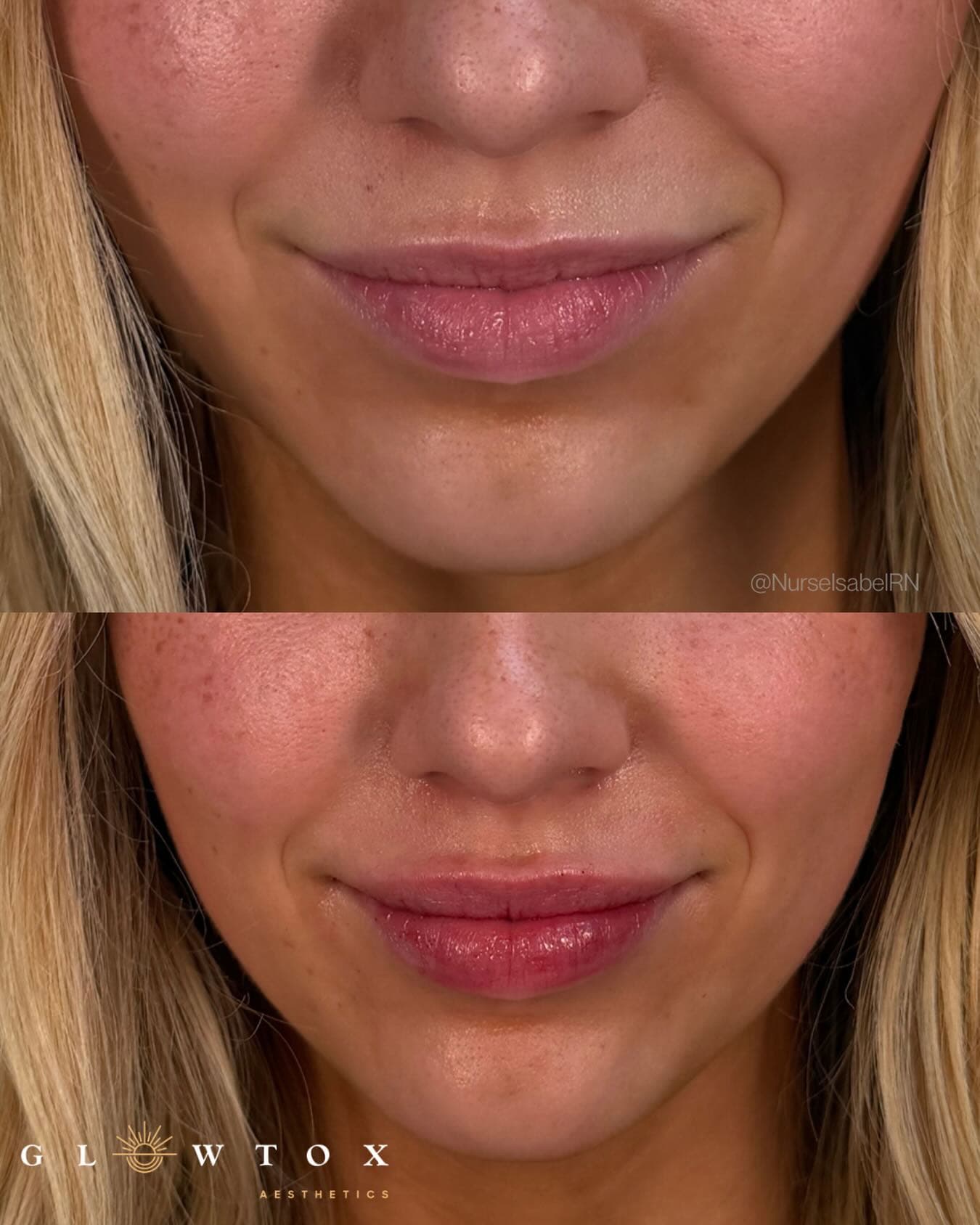 Lip filler before and after by Isabel, RN at Glowtox