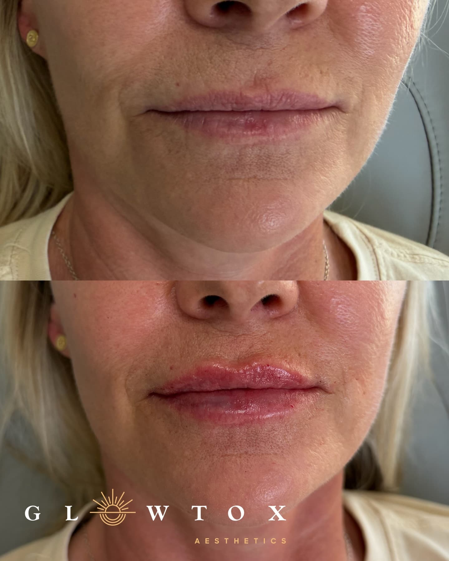 Lip filler before and after on a mature patient at Glowtox